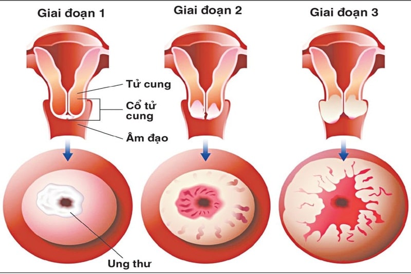 3 giai đoạn của bệnh ung thư cổ tử cung ở nữ giới