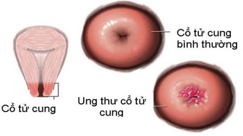 Hình ảnh bệnh ung thư cổ tử cung