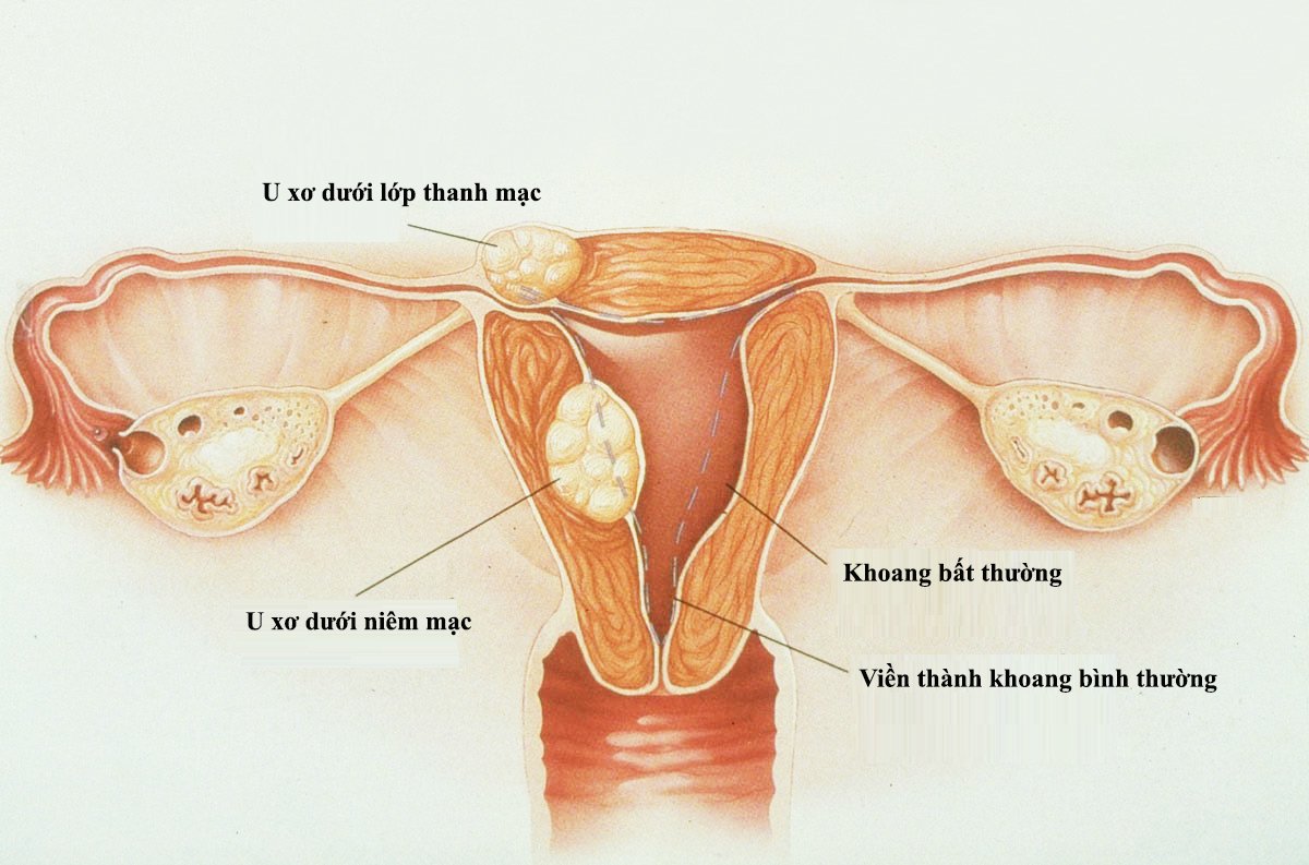 Tình trạng u xơ tử cung thường gặp ở nữ giới độ tuổi 30 - 40 tuổi.