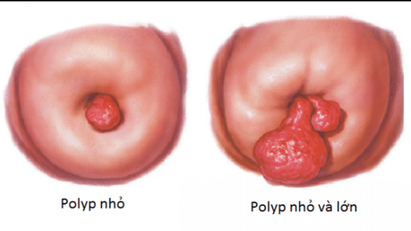 Hình ảnh polyp tử cung