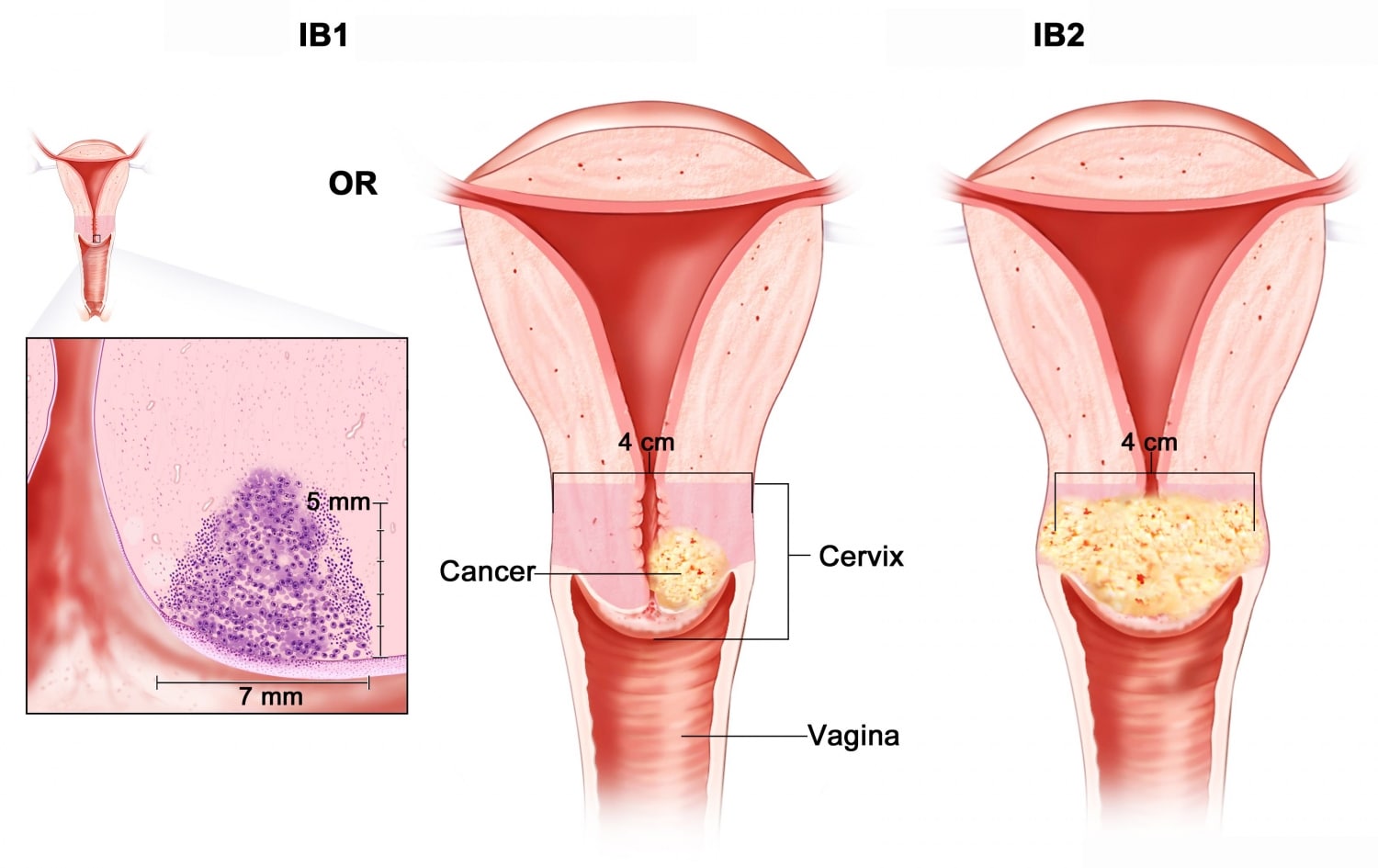 3 giai đoạn của bệnh ung thư cổ tử cung ở nữ giới