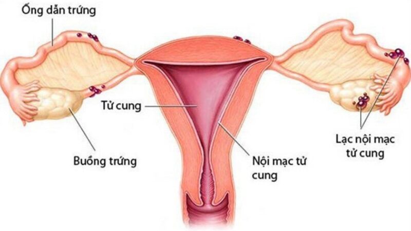 Hình ảnh mô phỏng lạc nội mạc tử cung