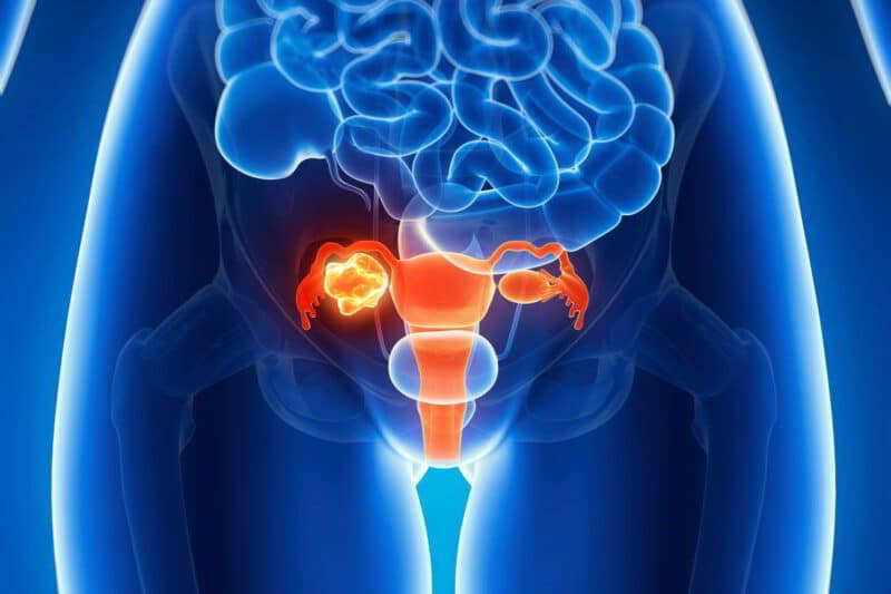 Tầm soát ung thư cổ tử cung là gì?
