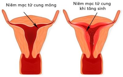 Hình ảnh mô phỏng niêm mạc tử cung mỏng